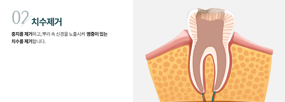 치수제거